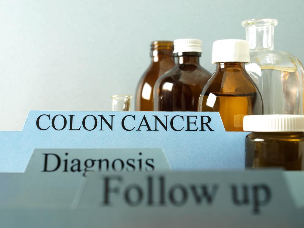 Colon Cancer &#8211; An Overview of the Stages