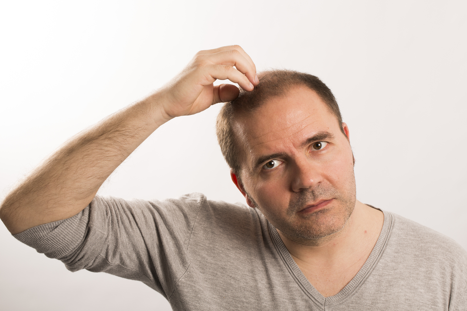 Male Pattern Baldness &#8211; Signs and Treatment